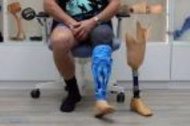 Prosthetics and Orthotics 3d Scanning